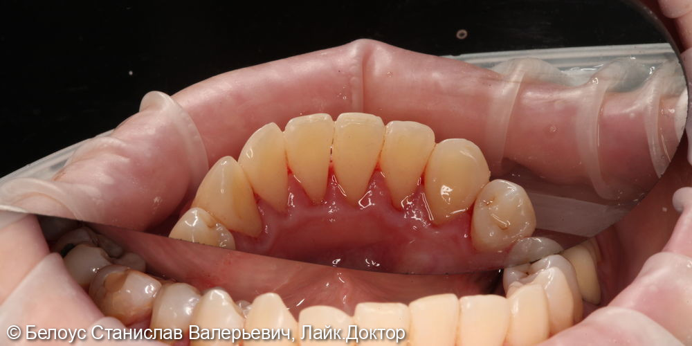 Гигиена полости рта и зубов - фото №2
