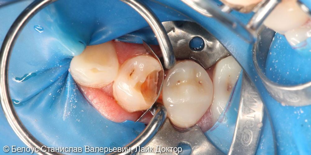 Лечение кариеса на 4.4 зубе - фото №2