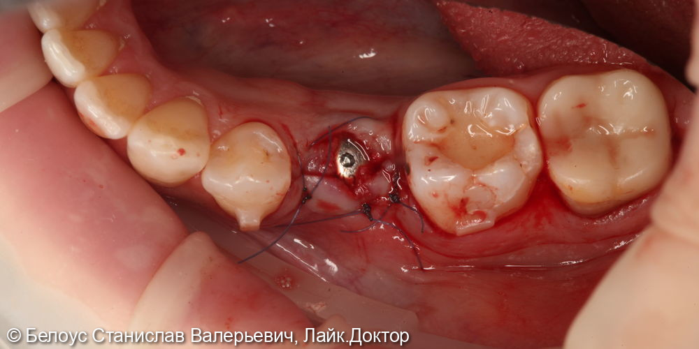 Установка импланта на 3.5 утраченном зубе - фото №5