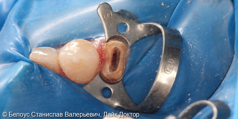 Лечение каналов, установка СВШ, керамическая коронка CAD/CAM на 1.4 зубе - фото №2