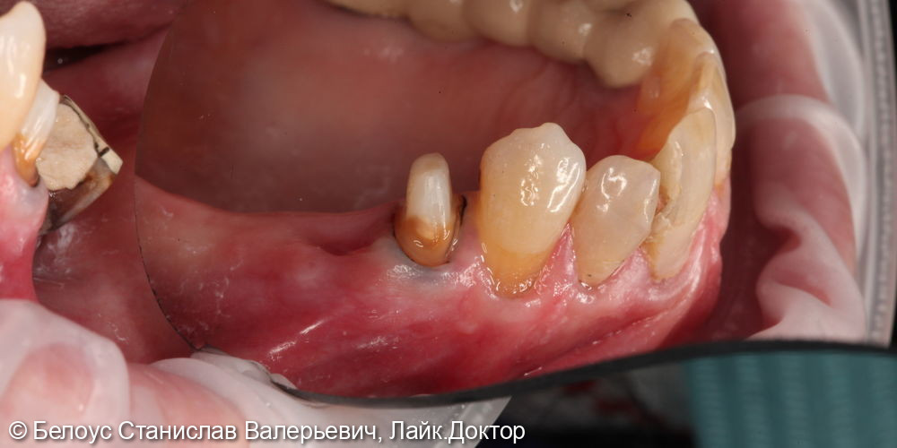 Лечение каналов, установка СВШ, керамическая коронка CAD/CAM на 1.4 зубе - фото №3