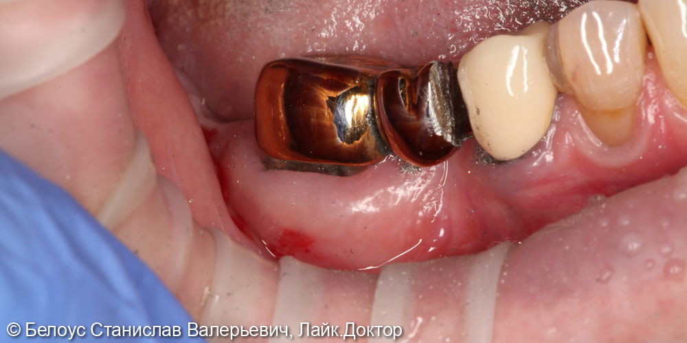 Снятие несъёмной ортопедической конструкции, удаление 4.7 зуба - фото №1