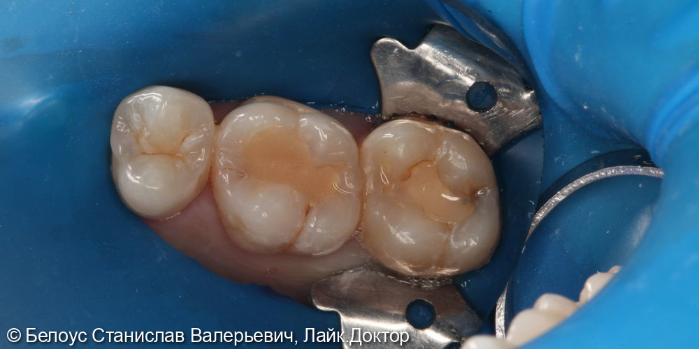 Лечение глубокого кариеса на жевательной поверхности 1.6 и 1.7 зуба - фото №1