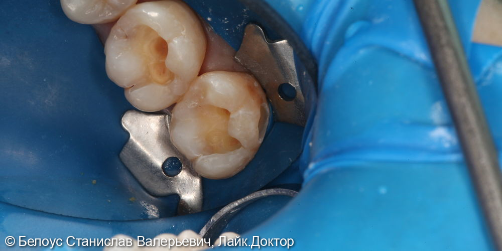 Лечение глубокого кариеса на жевательной поверхности 1.6 и 1.7 зуба - фото №2