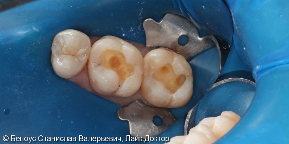 Лечение глубокого кариеса на жевательной поверхности 1.6 и 1.7 зуба - фото №3