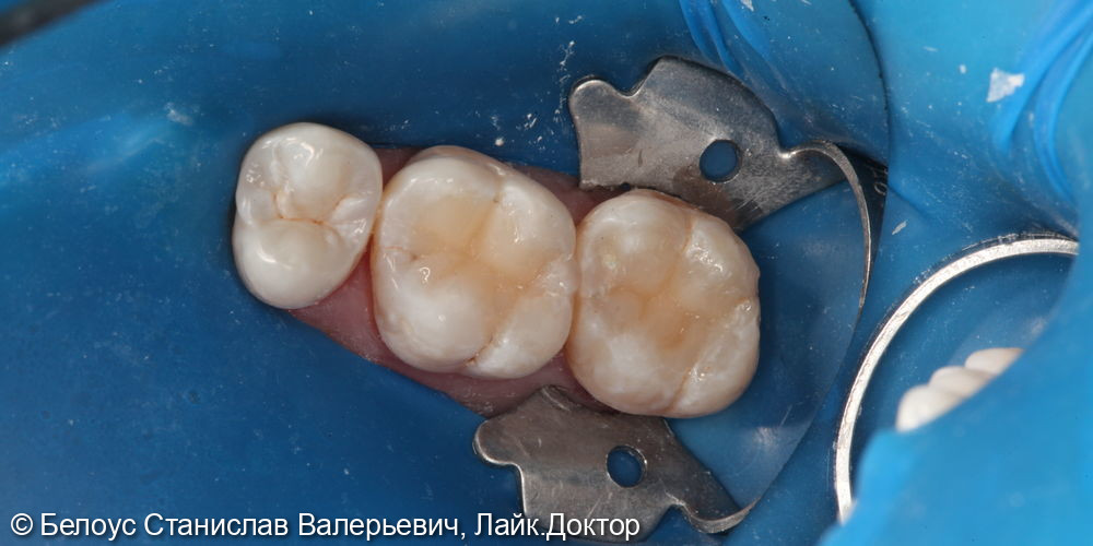 Лечение глубокого кариеса на жевательной поверхности 1.6 и 1.7 зуба - фото №4