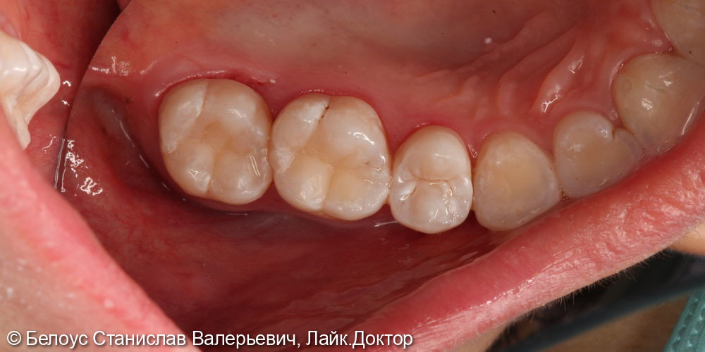 Лечение глубокого кариеса на жевательной поверхности 1.6 и 1.7 зуба - фото №5