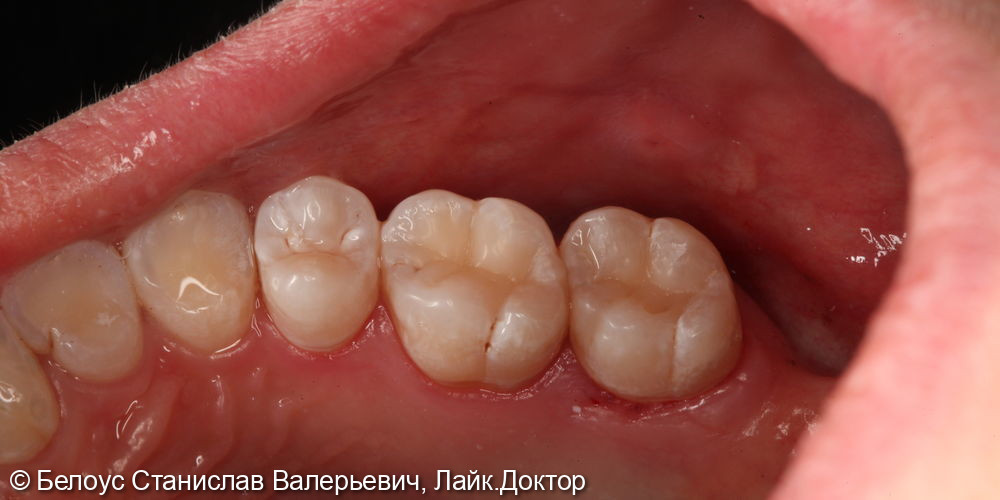 Лечение глубокого кариеса на жевательной поверхности 1.6 и 1.7 зуба - фото №6