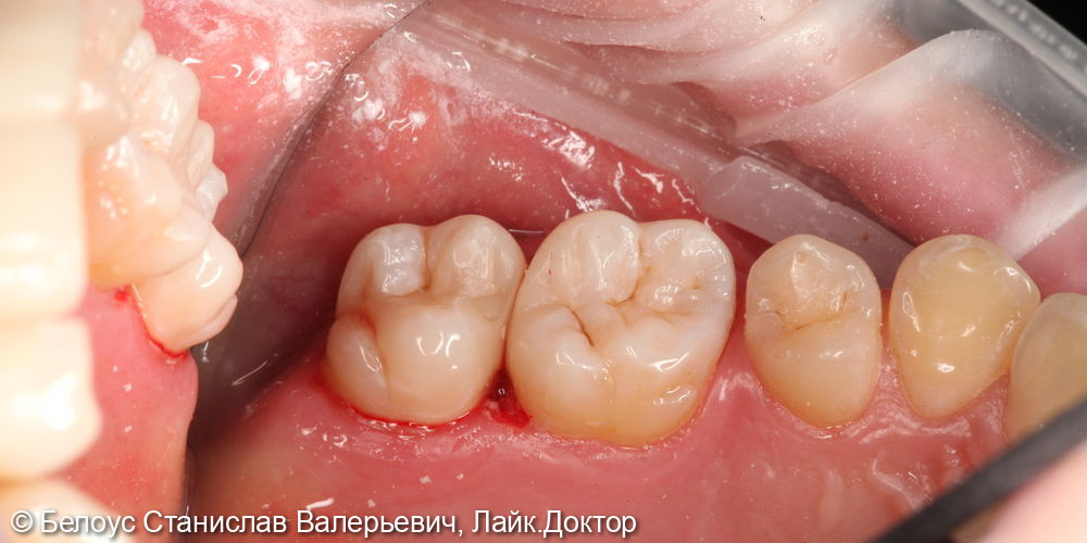 Лечение кариеса 2.6 и 2.7 зуба - фото №6