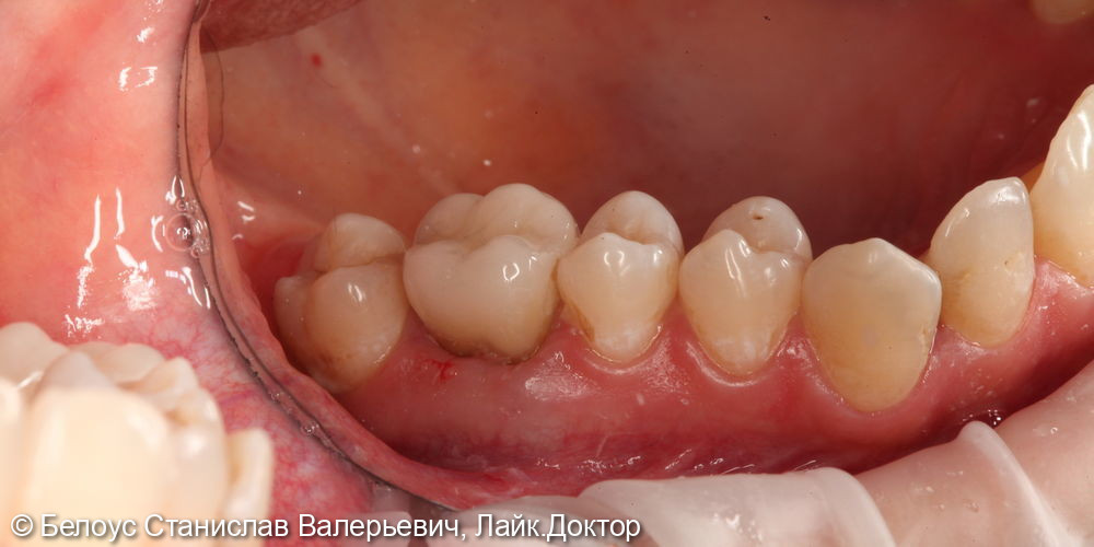 Лечение каналов, установка CAD/CAM коронки на 1.7 зубе - фото №5