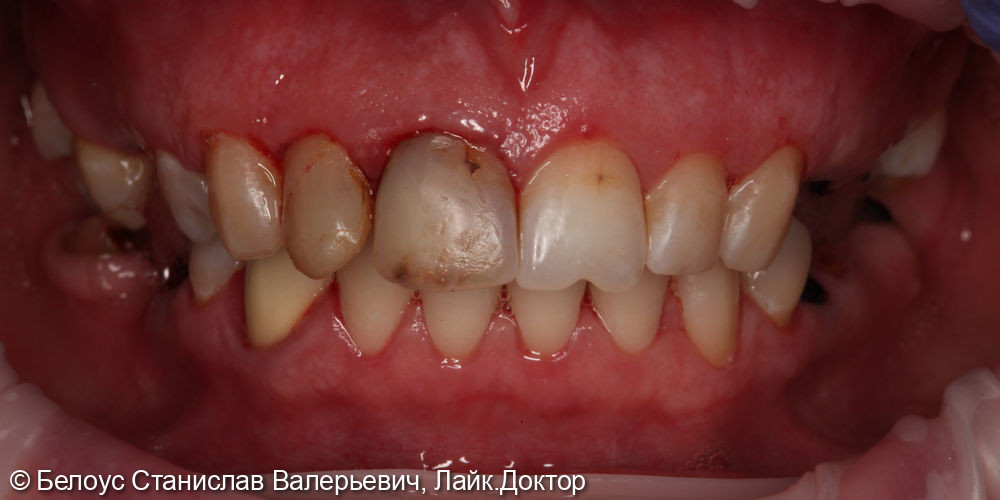 Лечение каналов и установка коронокCAD/CAM на 1.1 и 1.2 зубе - фото №1