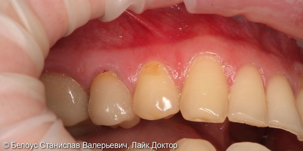 Лечение клиновидного дефекта 3.4 зуба - фото №1