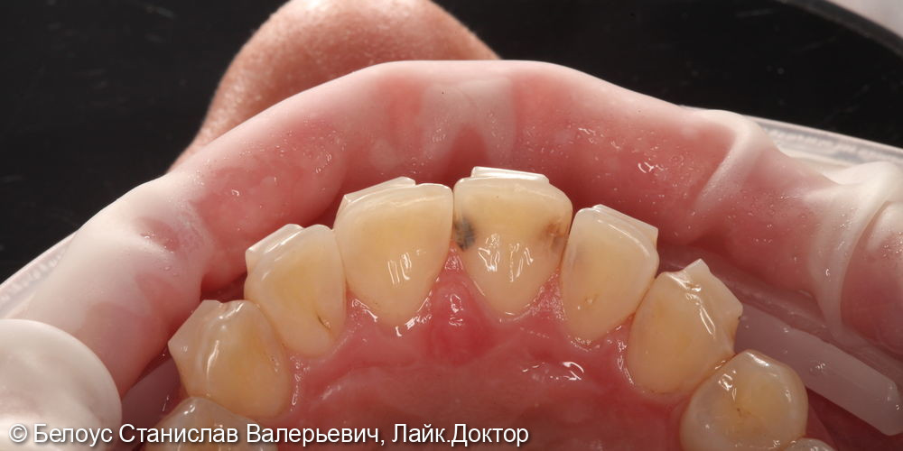 Лечение кариеса на 1.1 и 1.2 зубах - фото №1