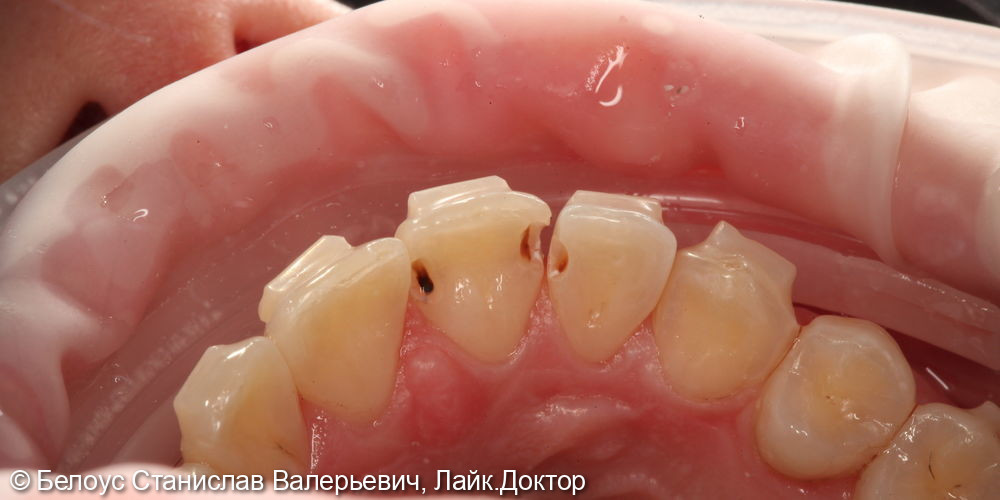 Лечение кариеса на 1.1 и 1.2 зубах - фото №2