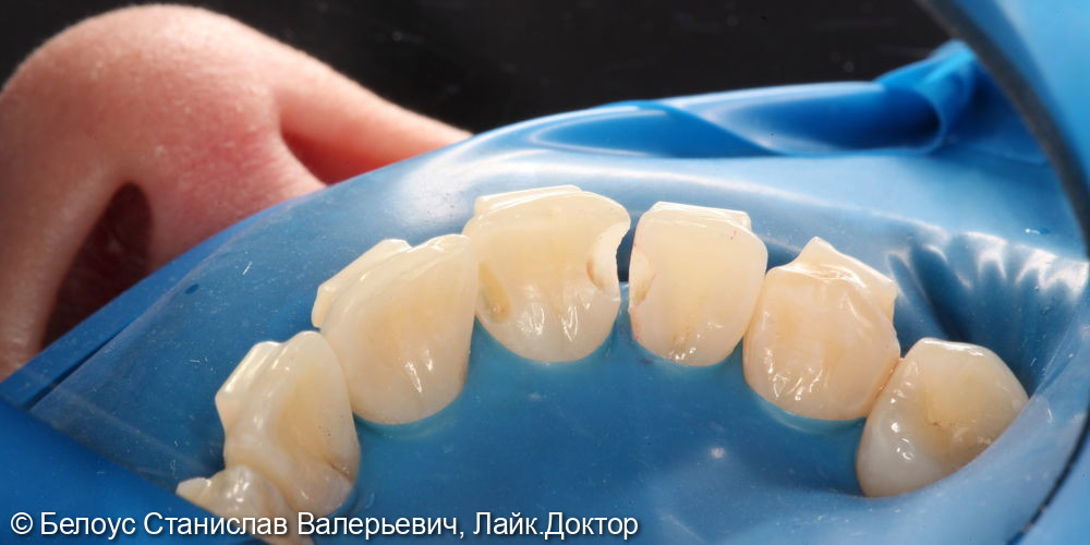 Лечение кариеса на 1.1 и 1.2 зубах - фото №3