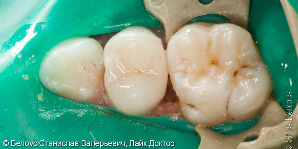 Установка керамической коронки CAD/CAM на 1.4 зубе - фото №2