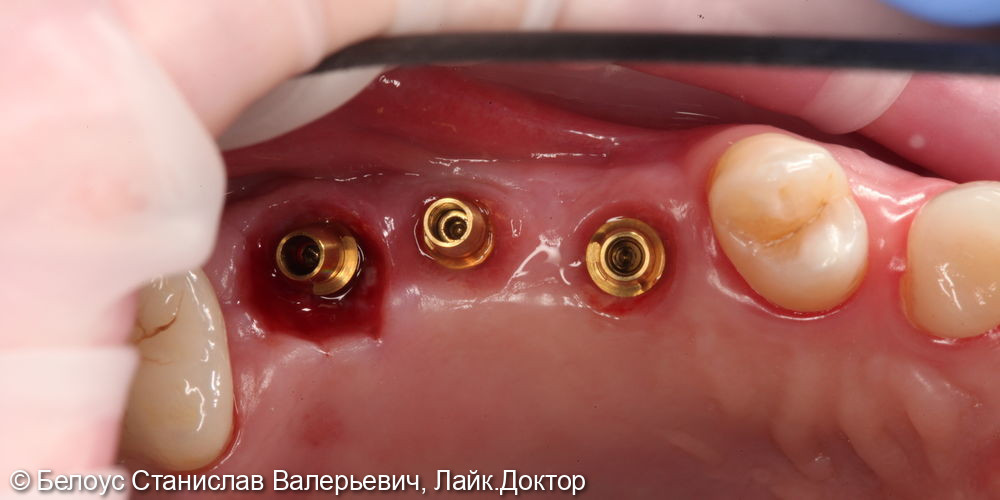 Установка винтовых коронок на импланте 2.4, 2.5, 2.6 зубов - фото №2
