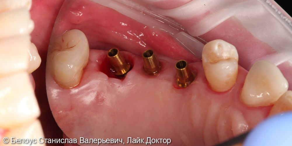 Установка винтовых коронок на импланте 2.4, 2.5, 2.6 зубов - фото №3