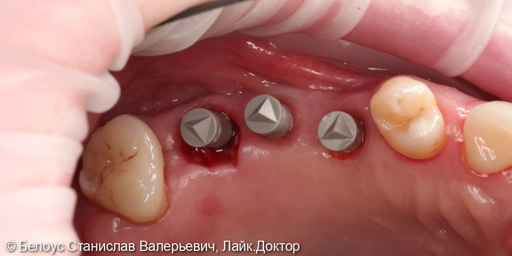 Установка винтовых коронок на импланте 2.4, 2.5, 2.6 зубов - фото №4