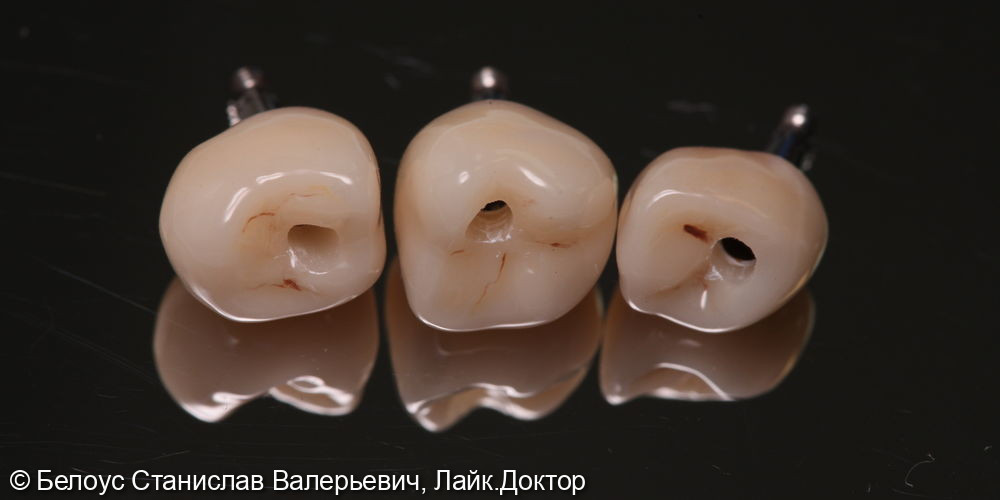 Установка винтовых коронок на импланте 2.4, 2.5, 2.6 зубов - фото №5