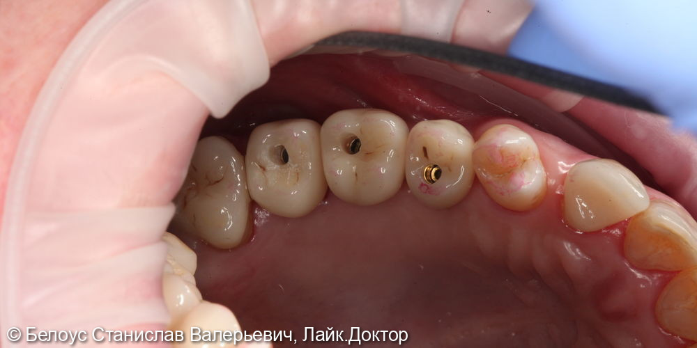 Установка винтовых коронок на импланте 2.4, 2.5, 2.6 зубов - фото №6