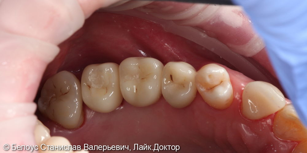 Установка винтовых коронок на импланте 2.4, 2.5, 2.6 зубов - фото №7