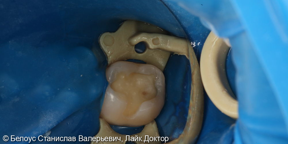 Лечение глубокого кариеса жевательного зуба 4.7 - фото №2