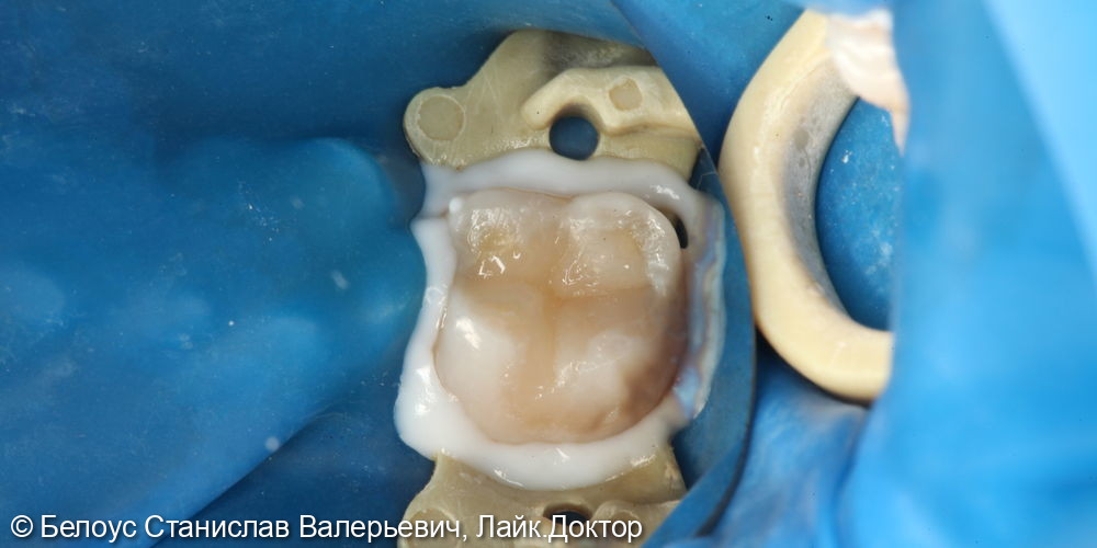 Лечение глубокого кариеса жевательного зуба 4.7 - фото №3