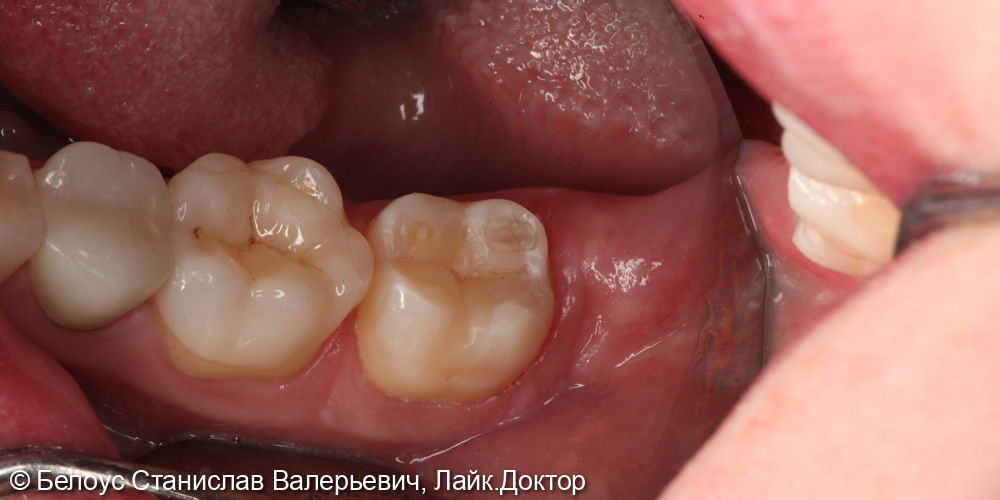 Лечение глубокого кариеса жевательного зуба 4.7 - фото №4