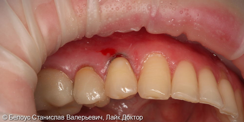 Лечение клиновидного дефекта на 3.4 зубе - фото №2