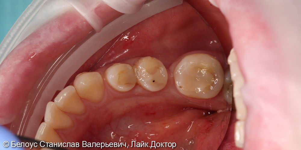 Лечение кариеса на 3.4 зубе - фото №1