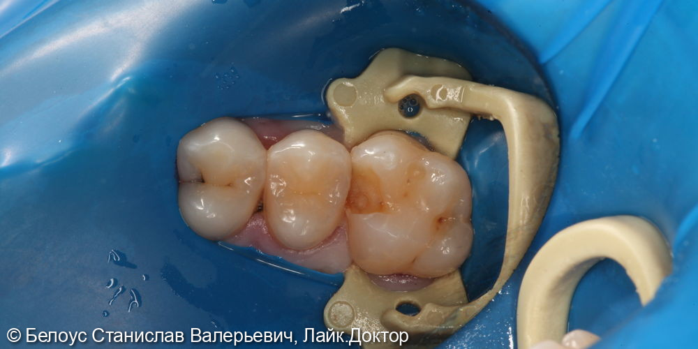 Лечение глубокого кариеса на жевательной поверхности 1.5 и 1.6 зуба - фото №1
