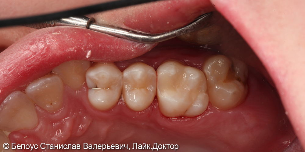 Лечение глубокого кариеса на жевательной поверхности 1.5 и 1.6 зуба - фото №3