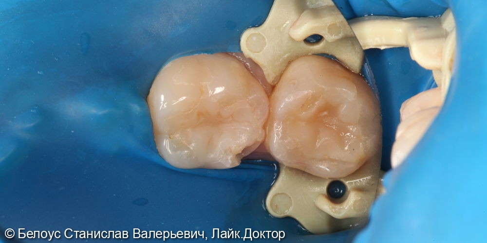 Лечение глубокого кариеса на жевательной поверхности 3.6 зуба - фото №1