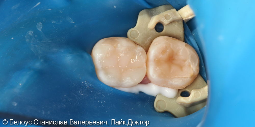 Лечение глубокого кариеса на жевательной поверхности 3.6 зуба - фото №4
