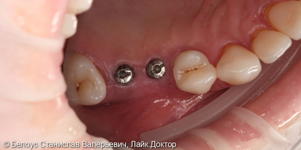 Установка коронок на импланты по технологии CEREC на 1.4, 1.5 зубе - фото №1