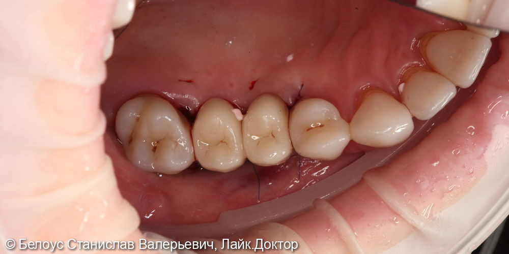 Установка коронок на импланты по технологии CEREC на 1.4, 1.5 зубе - фото №5
