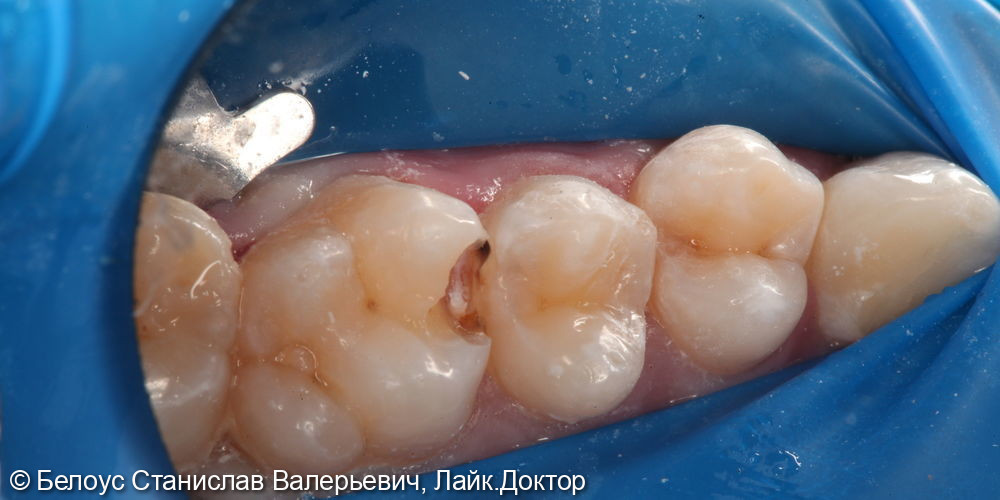 Лечение кариеса жевательных зубов 2.7,2.6,2.5 зубов - фото №3