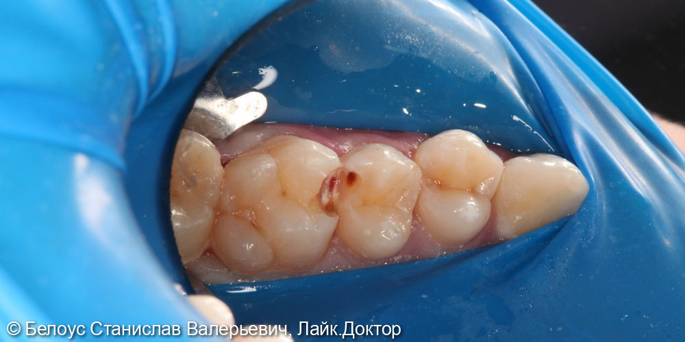 Лечение кариеса жевательных зубов 2.7,2.6,2.5 зубов - фото №4