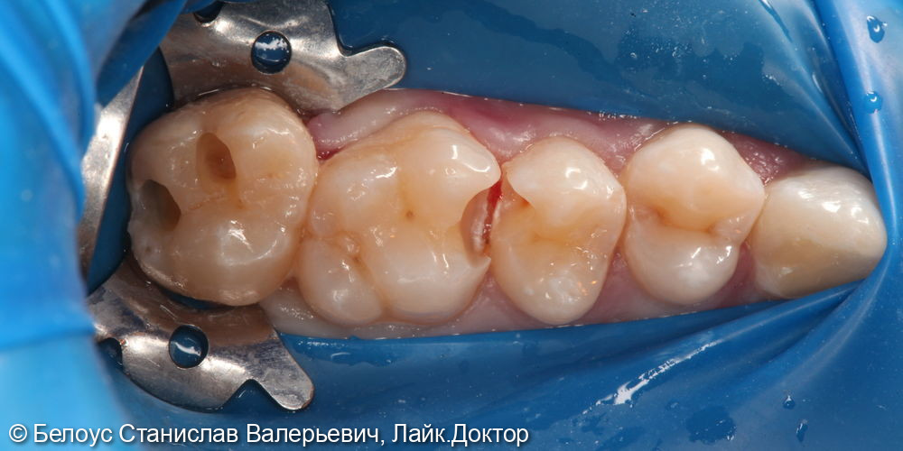 Лечение кариеса жевательных зубов 2.7,2.6,2.5 зубов - фото №5