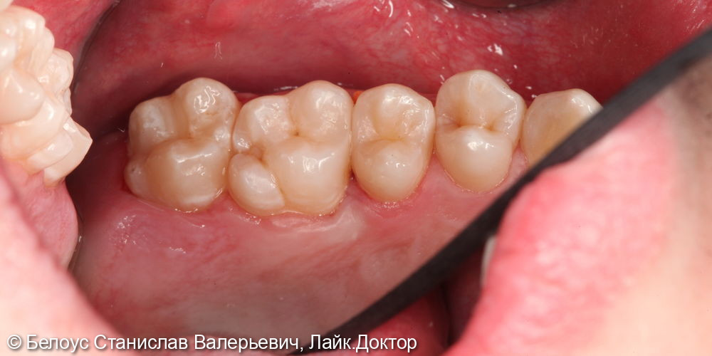 Лечение кариеса жевательных зубов 2.7,2.6,2.5 зубов - фото №6