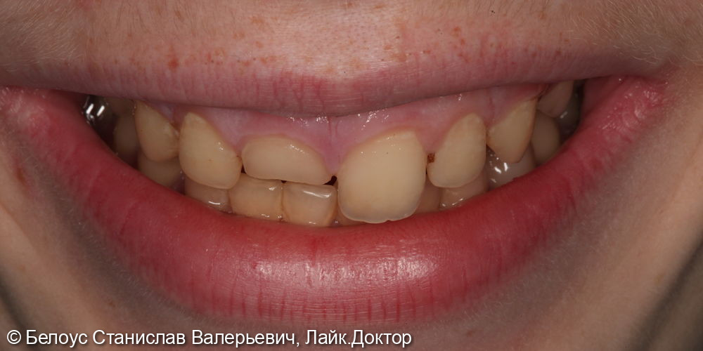 Лечение пульпита в 1.1 зубе и установка коронки CAD/CAM - фото №1