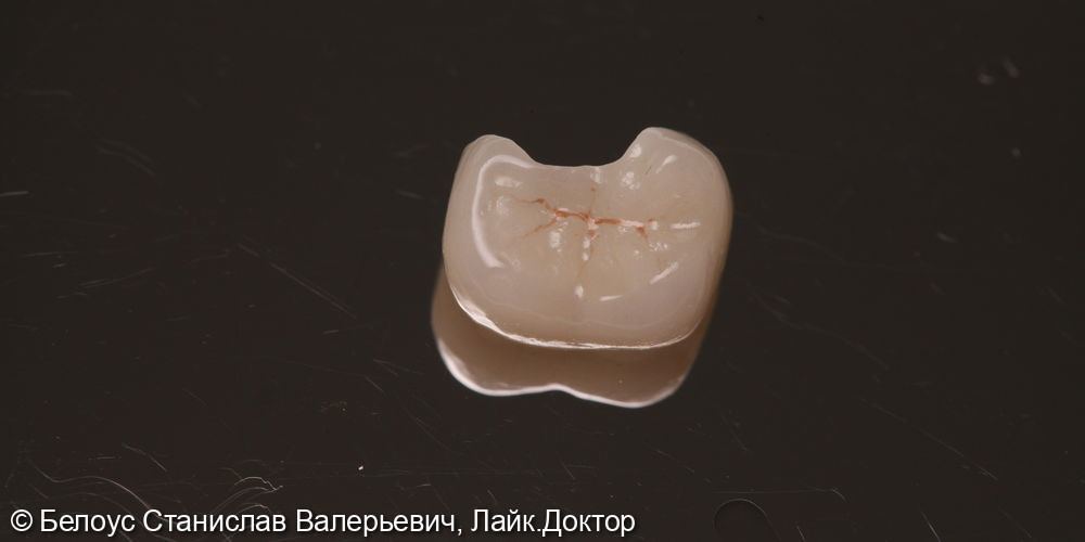 Установка керамической CAD/CAM коронки на 4.7 зубе - фото №3