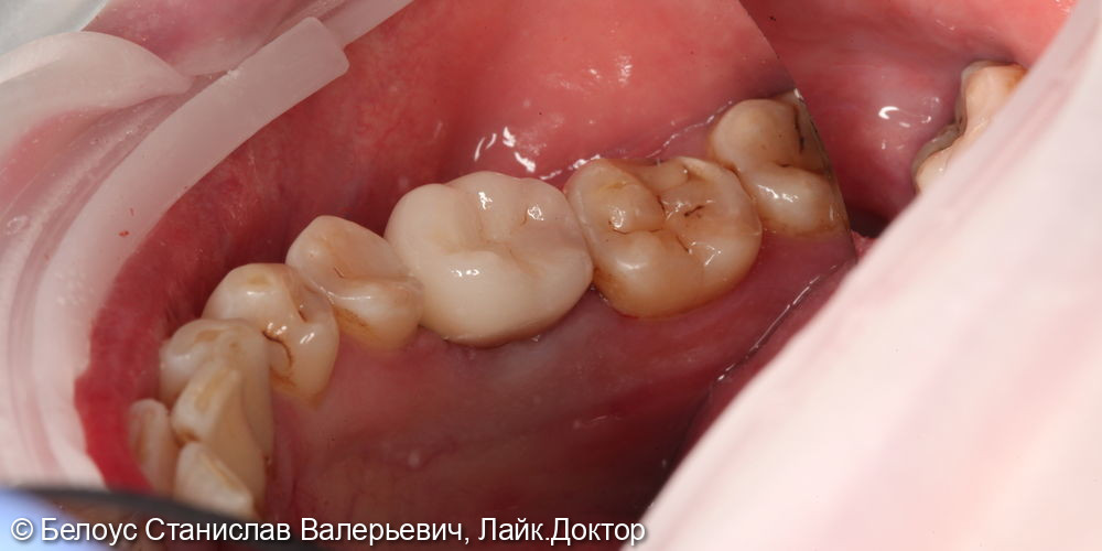 Лечение каналов и установка CAD/CAM коронки на 3.6 зубе - фото №5