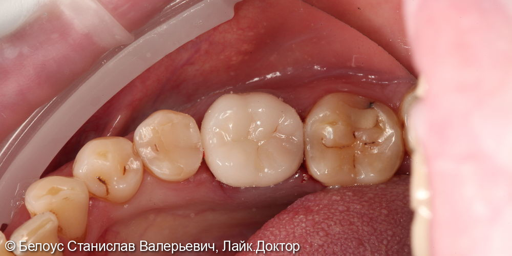 Лечение каналов и установка CAD/CAM коронки на 3.6 зубе - фото №6