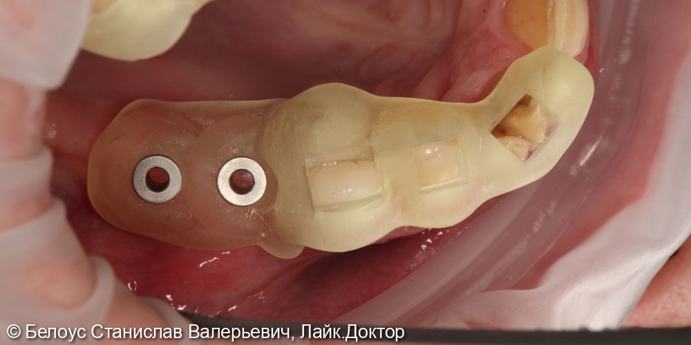 Установка имплантов 1.5,1.6,4.6 зубов - фото №2