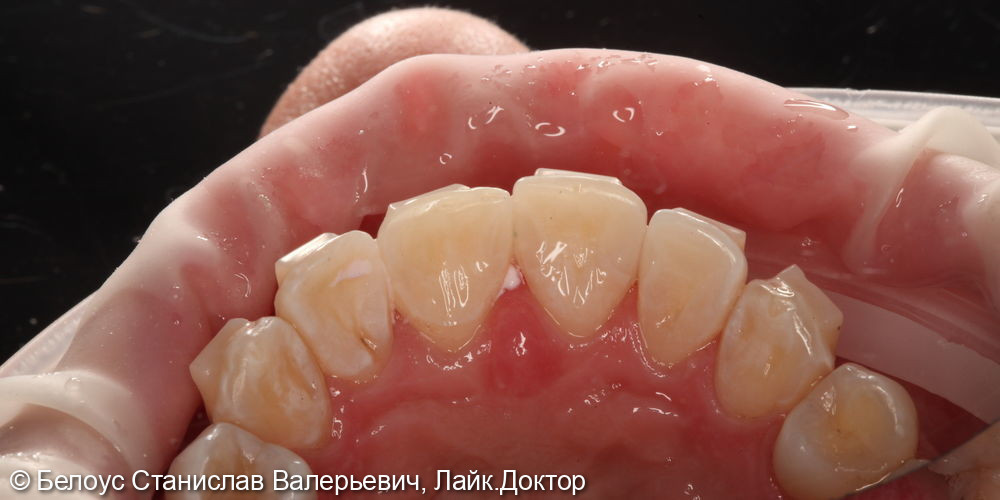 Лечение кариеса 1.1 и.1.2 зубов - фото №4