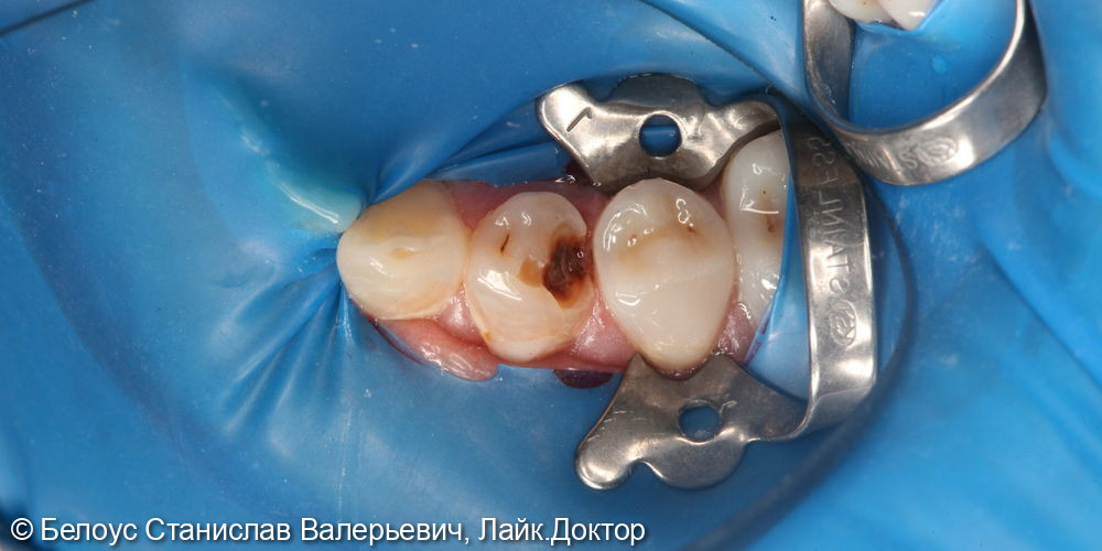 Лечение глубокого кариеса 4.4 зуба - фото №1