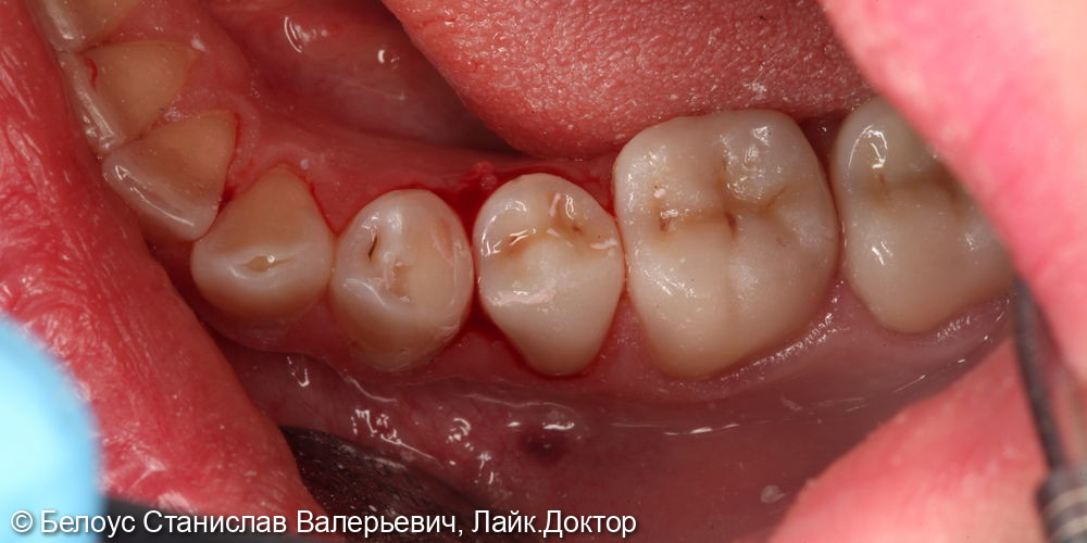 Лечение глубокого кариеса 4.4 зуба - фото №3