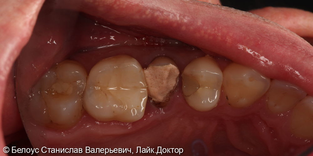 Лечение каналов и установка коронок на 2.4,2.5,2.6 зубе - фото №1